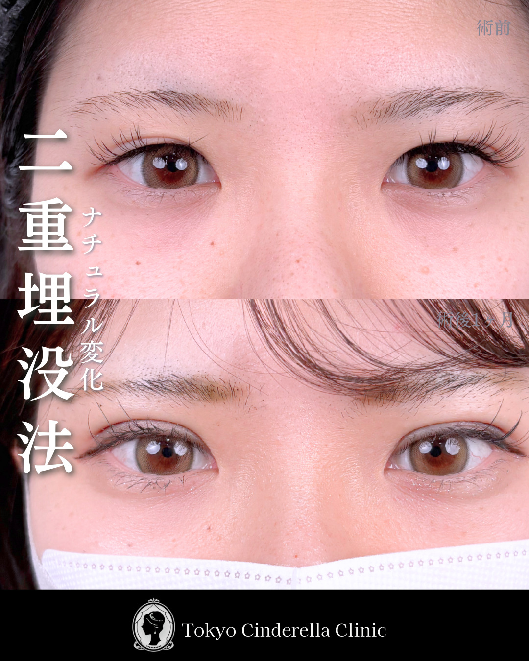 二重埋没法でナチュラルに垢抜け