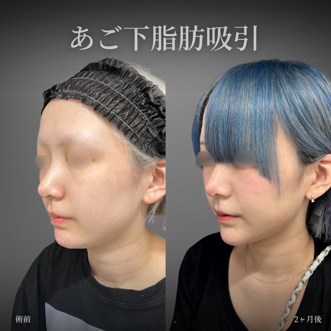 あご下の脂肪吸引をした女性の症例