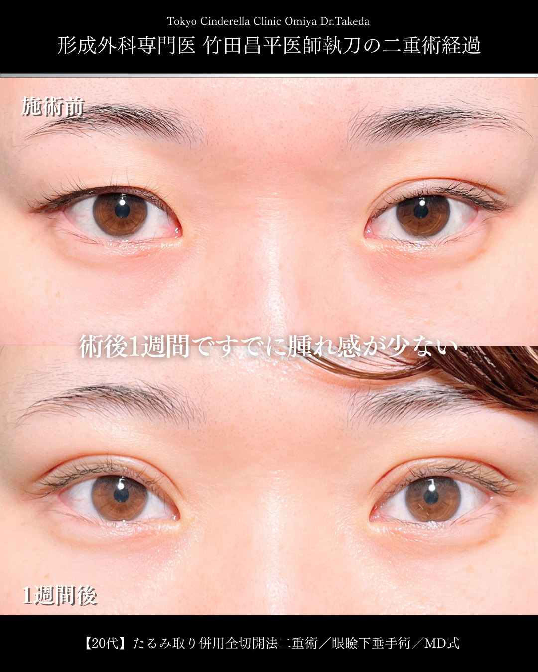 大宮院で行った二重整形で有名な名医の竹田昌平医師の全切開二重術と眼瞼下垂修正術の症例写真