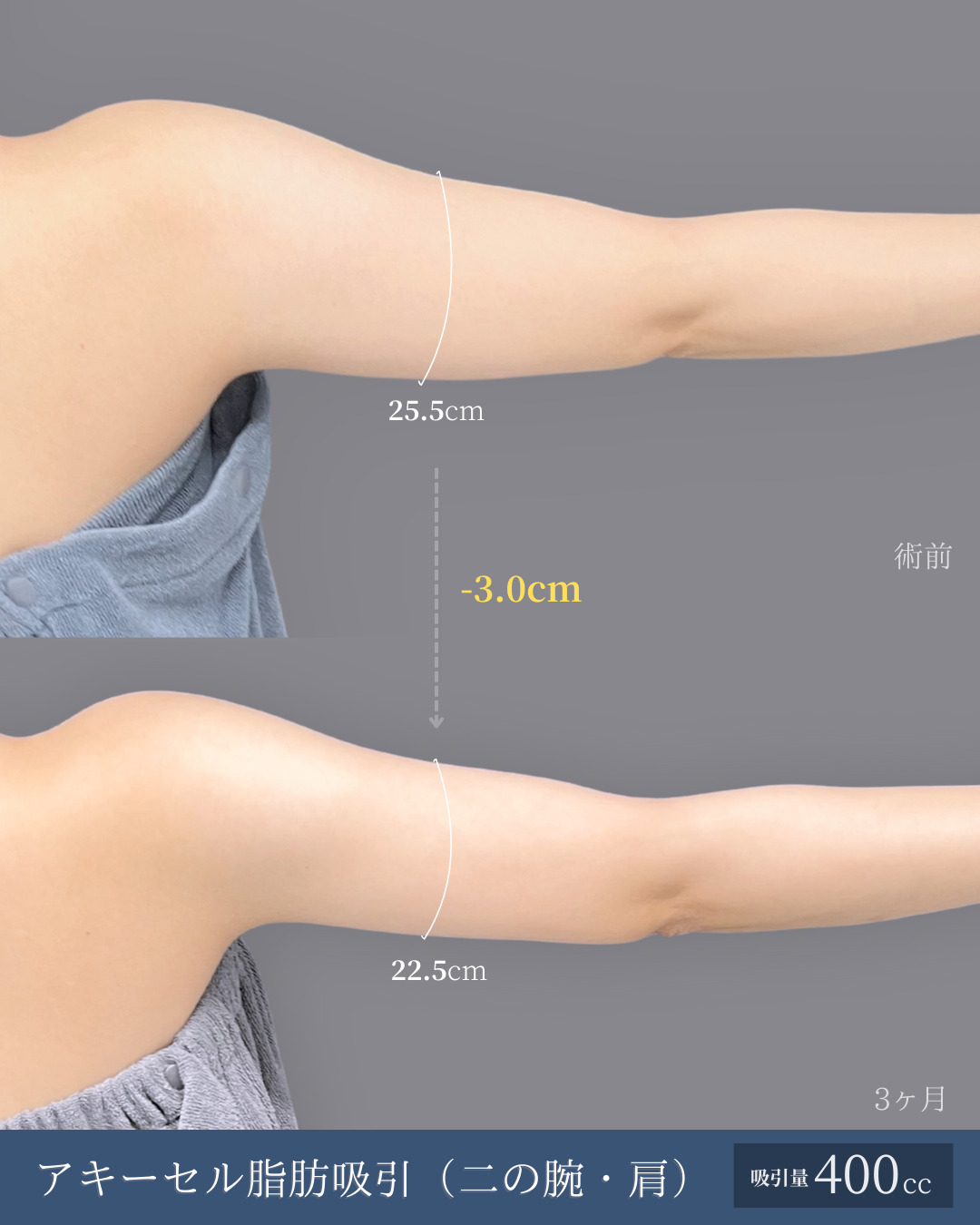 二の腕と肩のアキーセル脂肪吸引でサイズダウンした方の３ヶ月比較