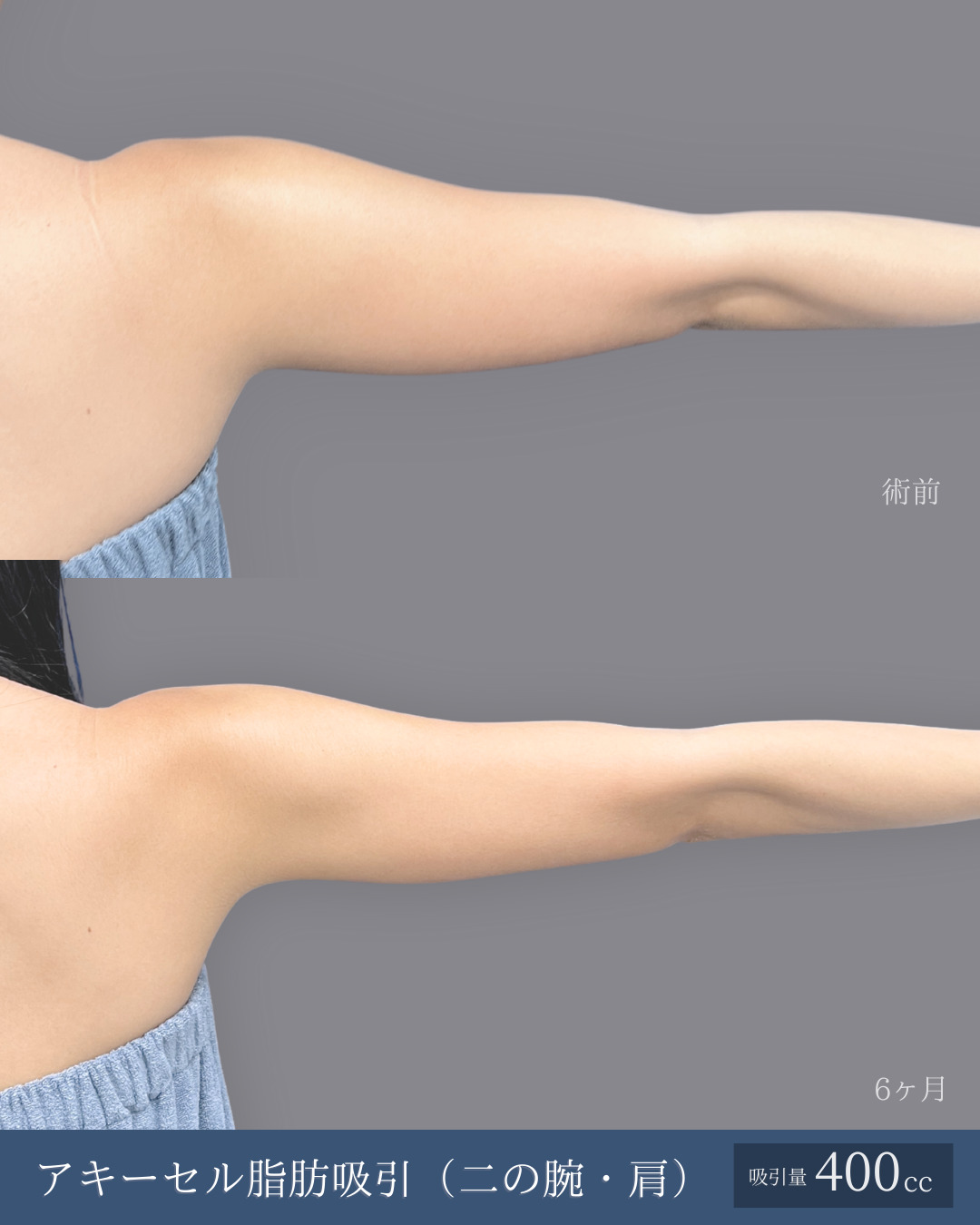 アキーセル脂肪吸引で二の腕しっかり細くなった方の６ヶ月比較