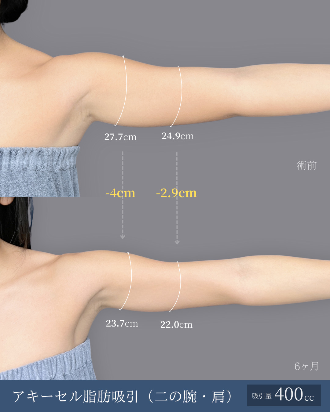 アキーセル脂肪吸引で二の腕しっかり細くなった方の６ヶ月比較