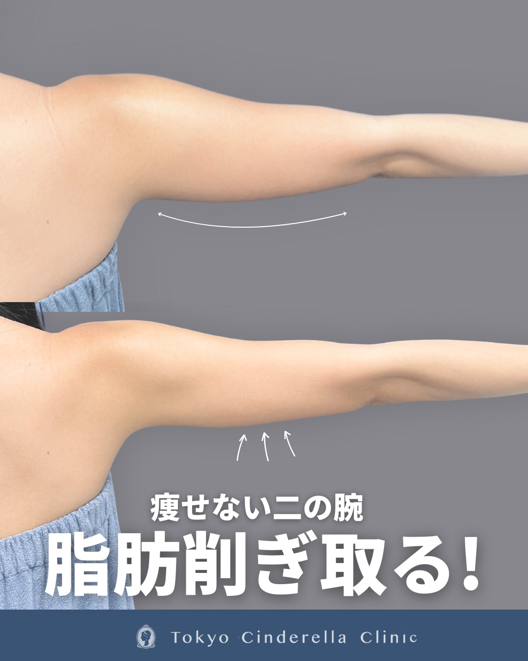アキーセル脂肪吸引で二の腕しっかり細くなった方の６ヶ月比較