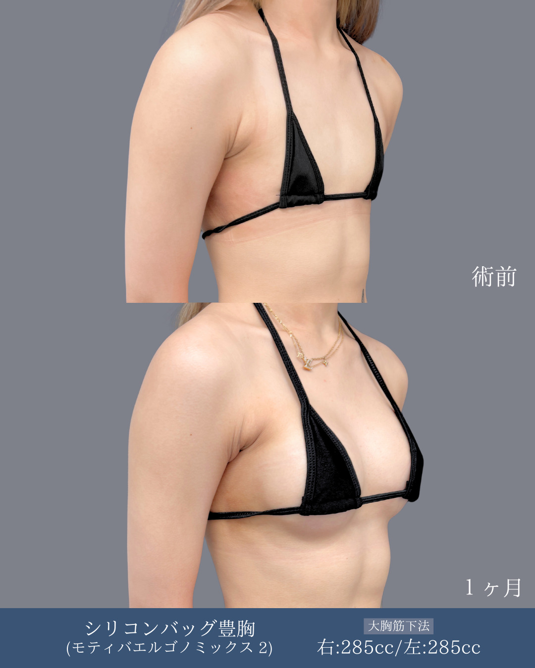 シリコンバッグ豊胸(モティバエルゴノミックス)でまな板胸がしっかりボリュームアップした方の１ヶ月目症例