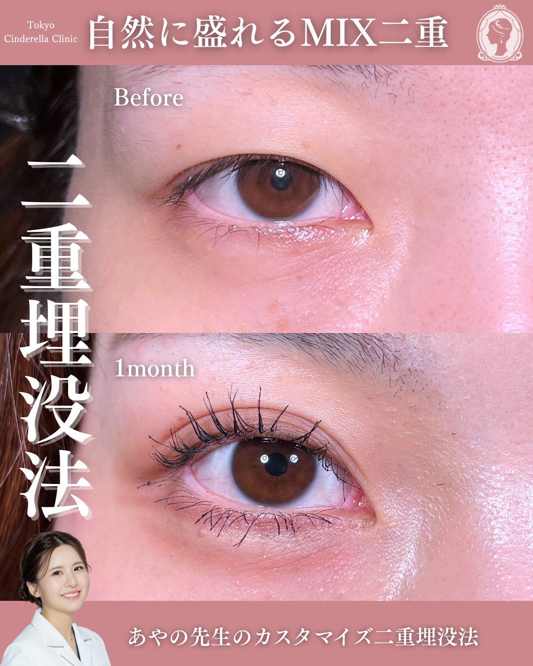 新宿院で行った二重埋没法の名医の梅田彩乃医師の症例写真