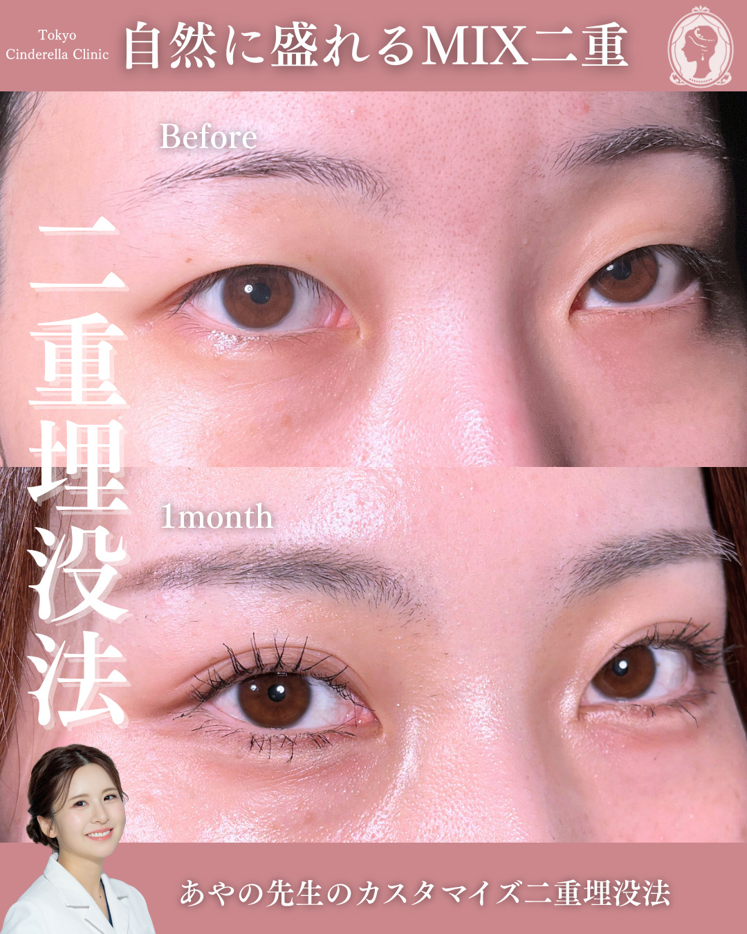 新宿院で行った二重埋没法の名医の梅田彩乃医師の症例写真
