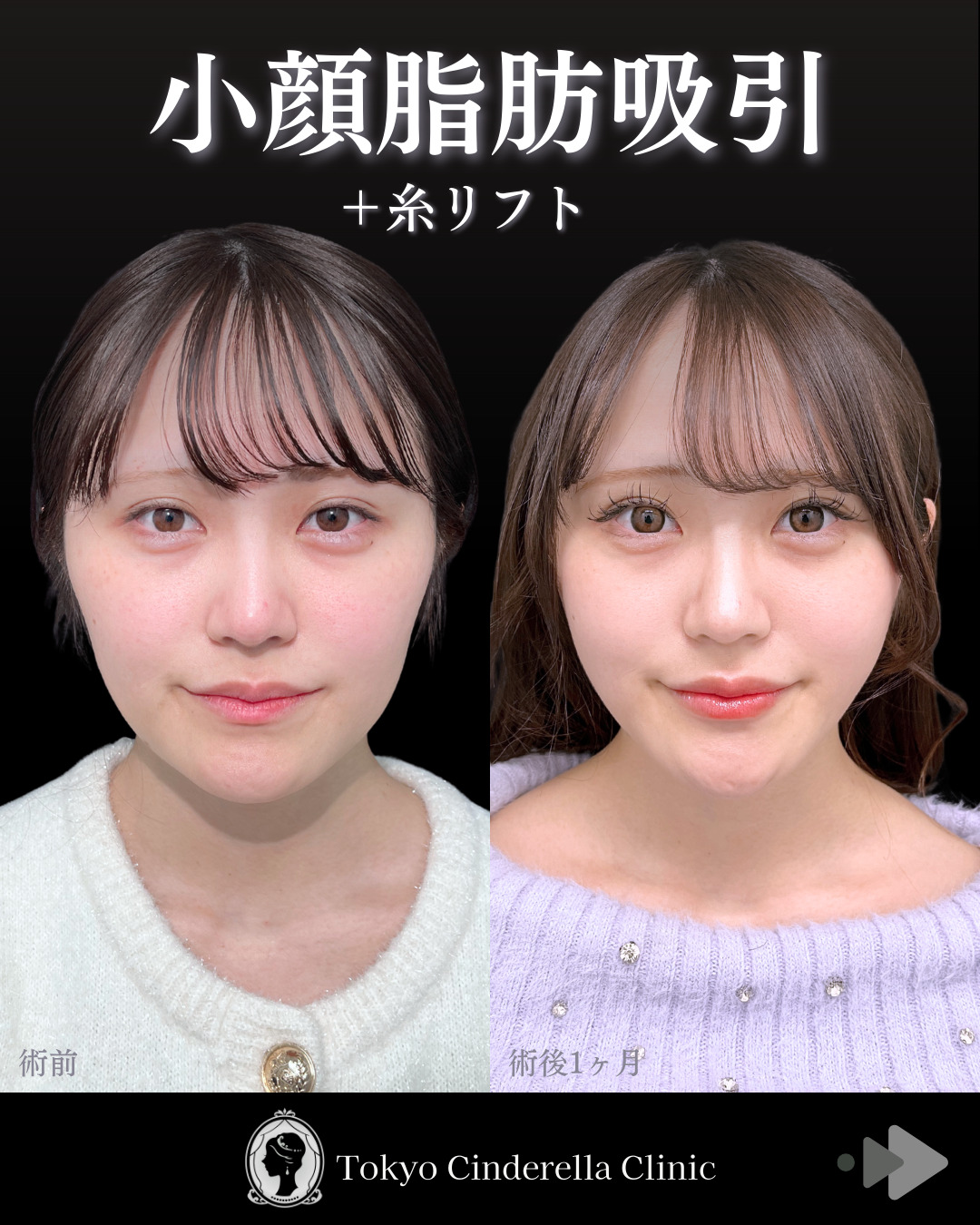 綺麗なフェイスラインに