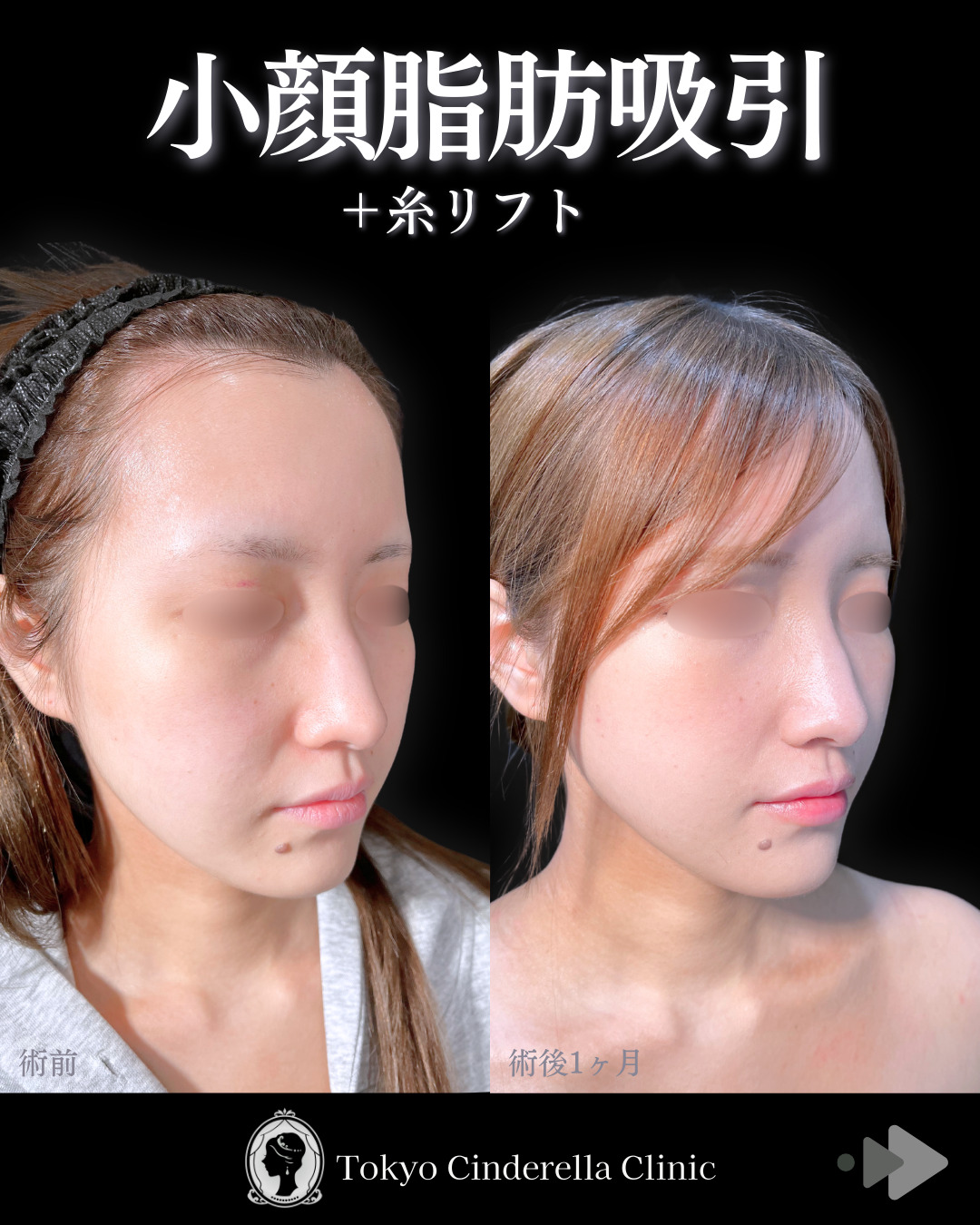 池袋院で行ったアキーセル小顔脂肪吸引(頬・あご下・エラ下・ジョールファット) と糸リフト６本と他院修正整形で有名な名医の石井達也の症例写真