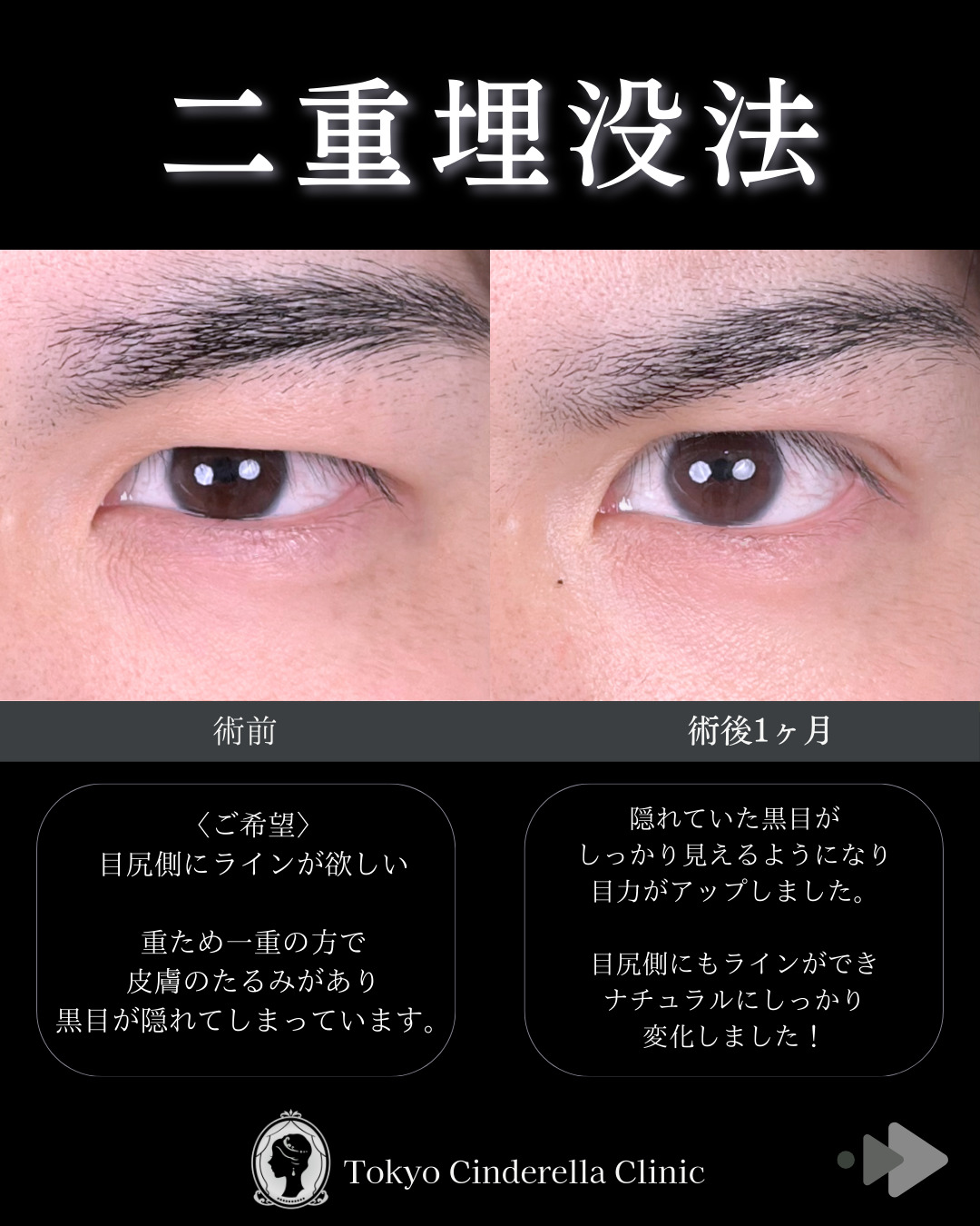 池袋院で行った二重埋没法整形の名医の症例写真
