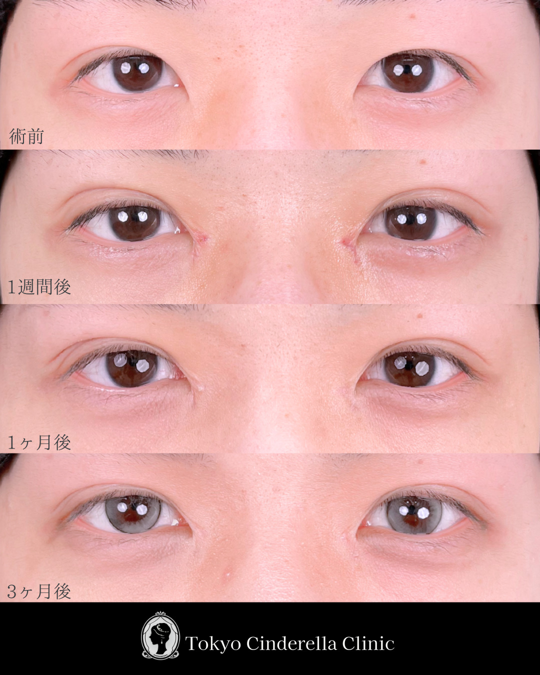 池袋院で行った目元整形で有名な名医の二重埋没法と目頭切開の症例写真