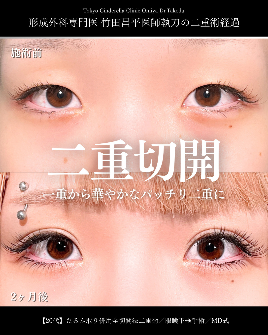 大宮院で行った二重整形で有名な竹田昌平医師の全切開二重術と眼瞼下垂手術の症例写真
