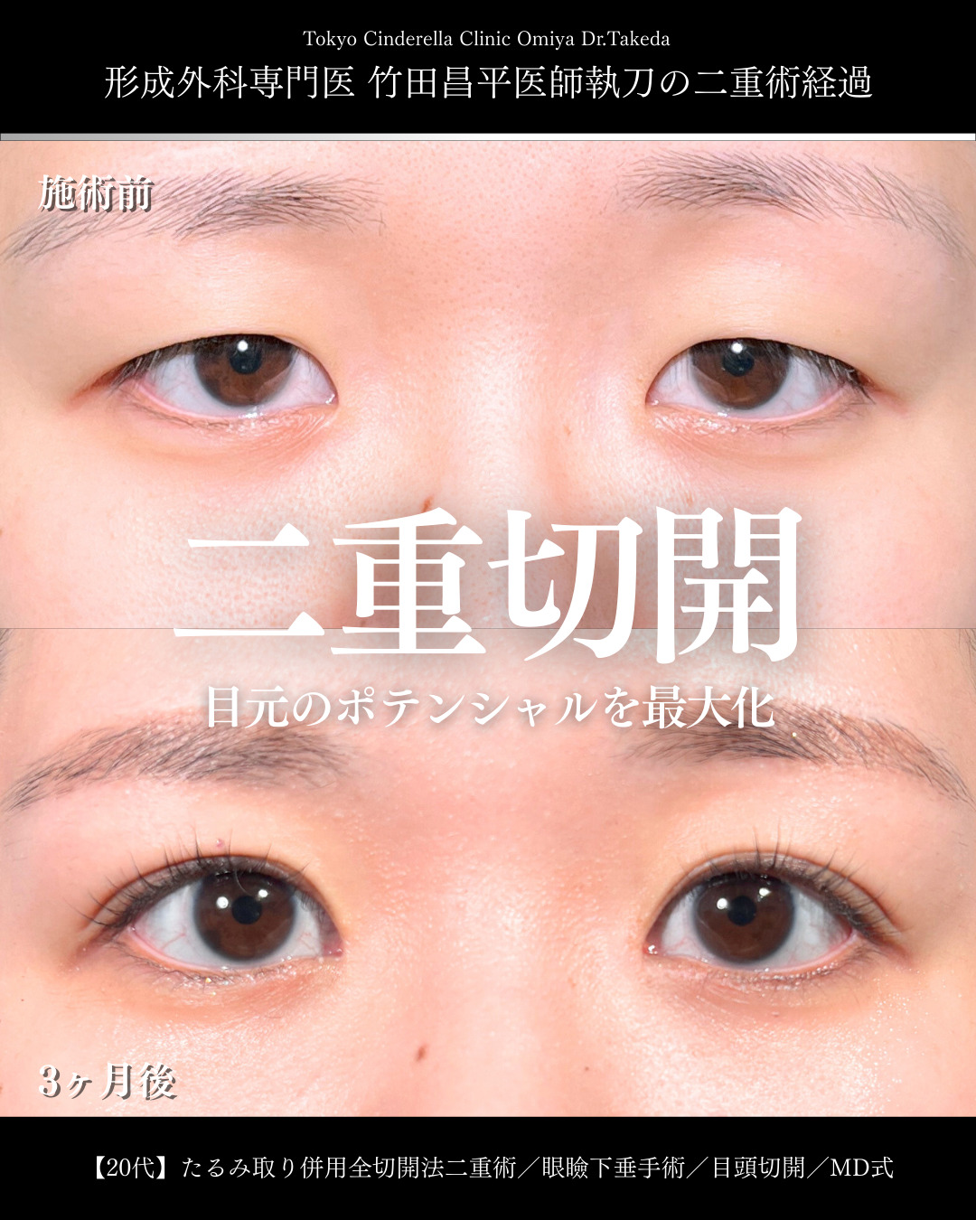大宮院で行った二重整形で有名な竹田昌平医師の全切開二重術と眼瞼下垂手術と目頭切開の症例写真
