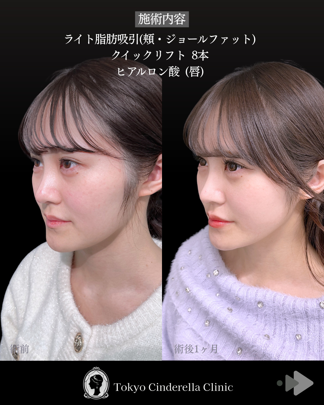 池袋院で行ったライト脂肪吸引(頬・ジョールファット) と糸リフト8本とヒアルロン酸(唇)整形の名医の症例写真