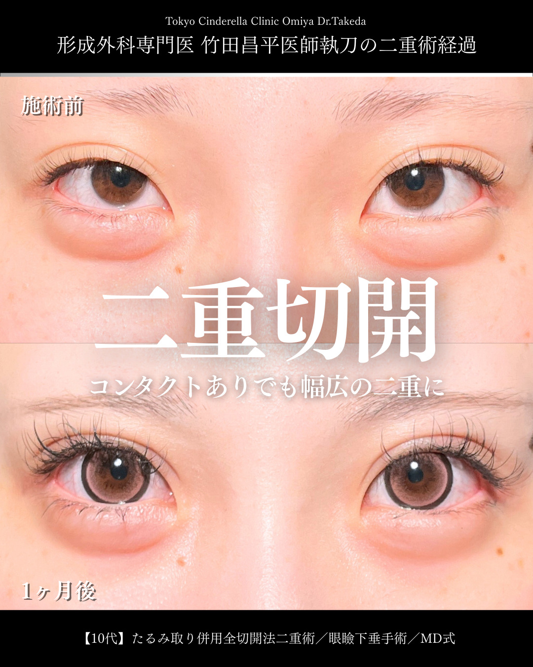 大宮院で行った二重整形で有名な名医の全切開二重術と眼瞼下垂修正術の症例写真