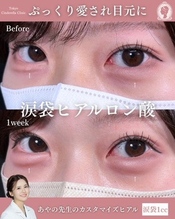 新宿院で行ったヒアルロン酸注入の名医の梅田彩乃医師の症例写真