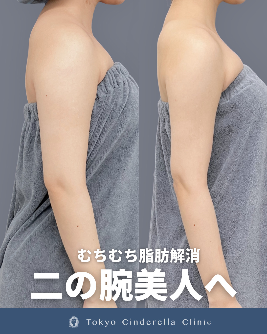 ムチっと腕が解消