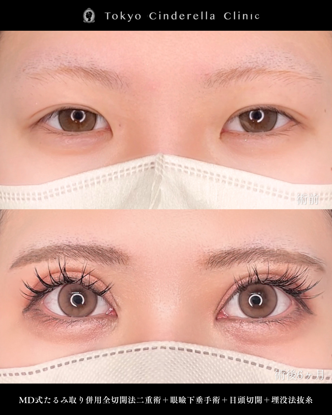 蒙古襞を解除し目の開きがよくなり別人級目元になった症例