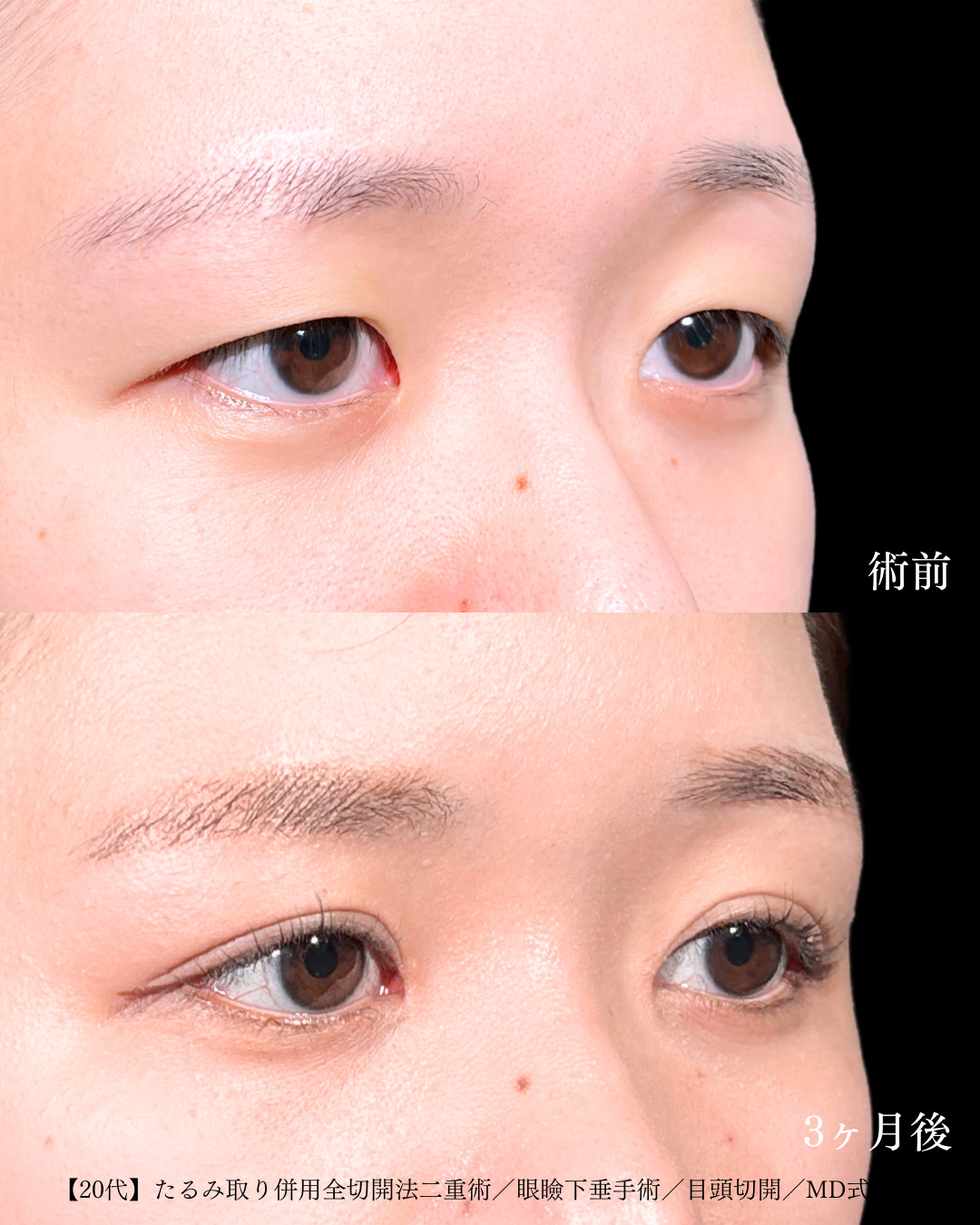 大宮院で行った二重整形で有名な竹田昌平医師の全切開二重術と眼瞼下垂手術と目頭切開の症例写真