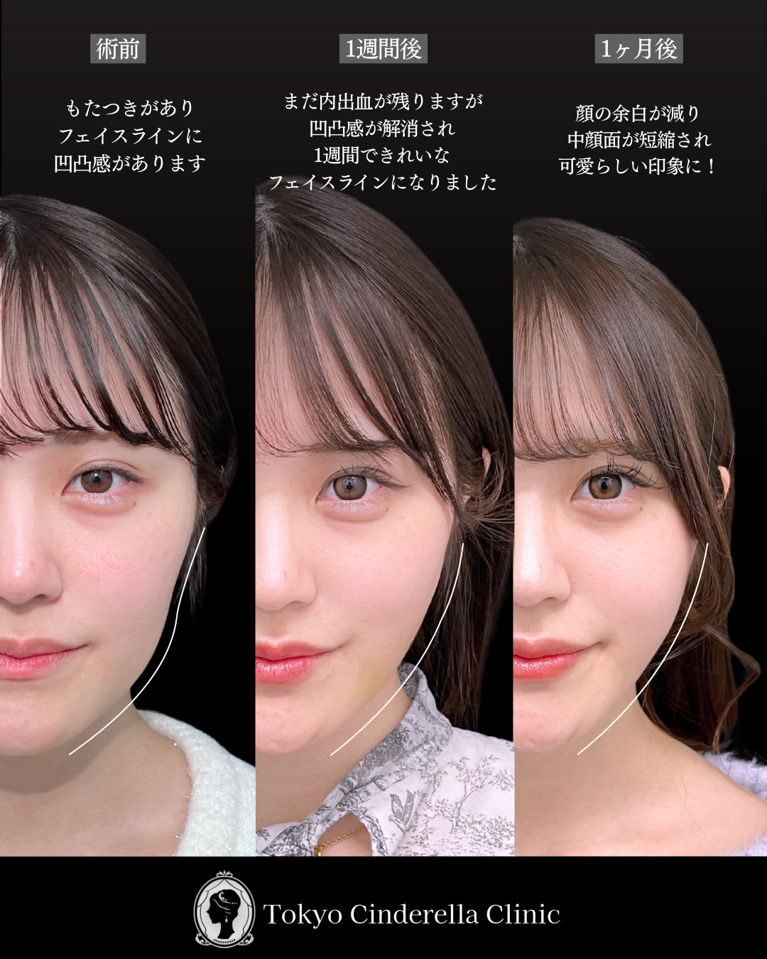 池袋院で行ったライト脂肪吸引(頬・ジョールファット) と糸リフト8本とヒアルロン酸(唇)整形の名医の症例写真