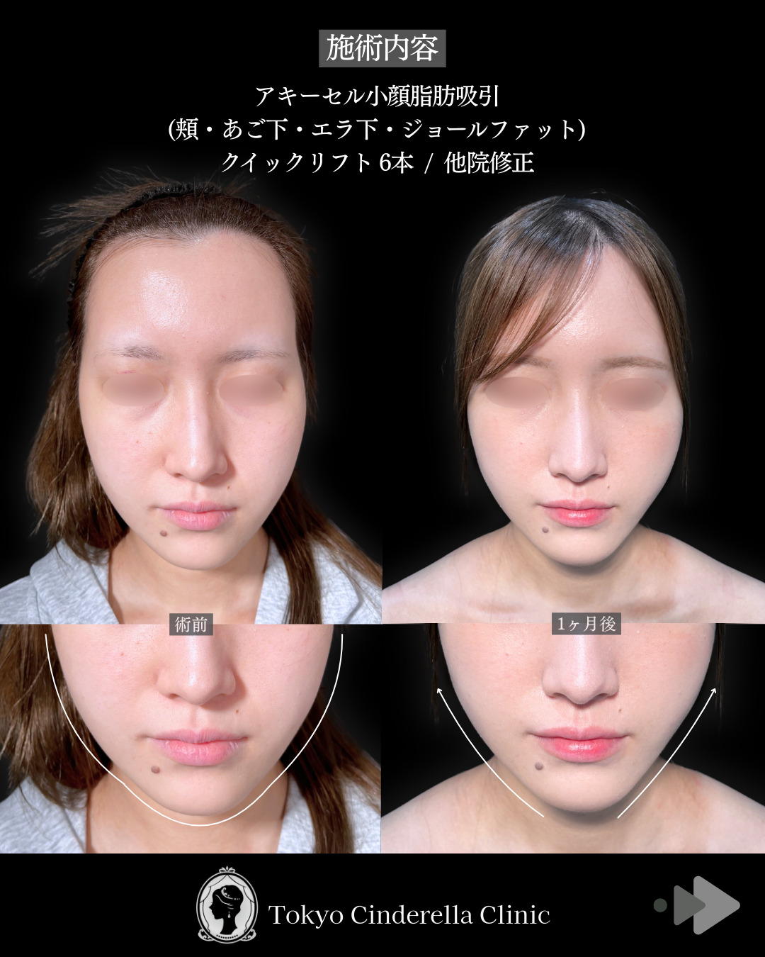池袋院で行ったアキーセル小顔脂肪吸引(頬・あご下・エラ下・ジョールファット) と糸リフト６本と他院修正整形で有名な名医の石井達也の症例写真