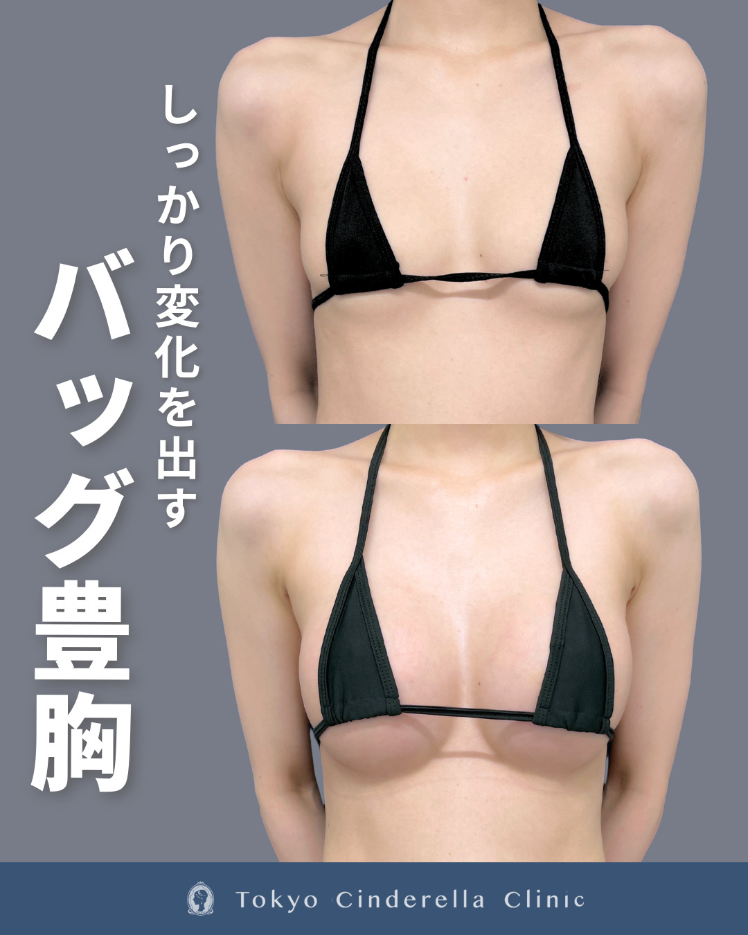 シリコンバッグ豊胸でハリのあるバストになった20代女性の１ヶ月の症例
