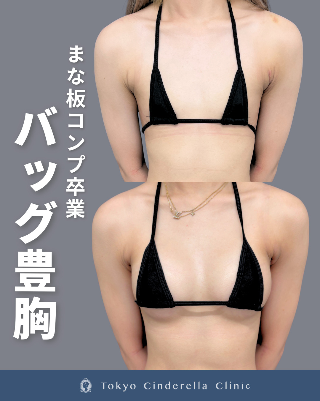 シリコンバッグ豊胸(モティバエルゴノミックス)でまな板胸がしっかりボリュームアップした方の１ヶ月目症例
