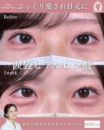 新宿院で行ったヒアルロン酸注入の名医の梅田彩乃医師の症例写真