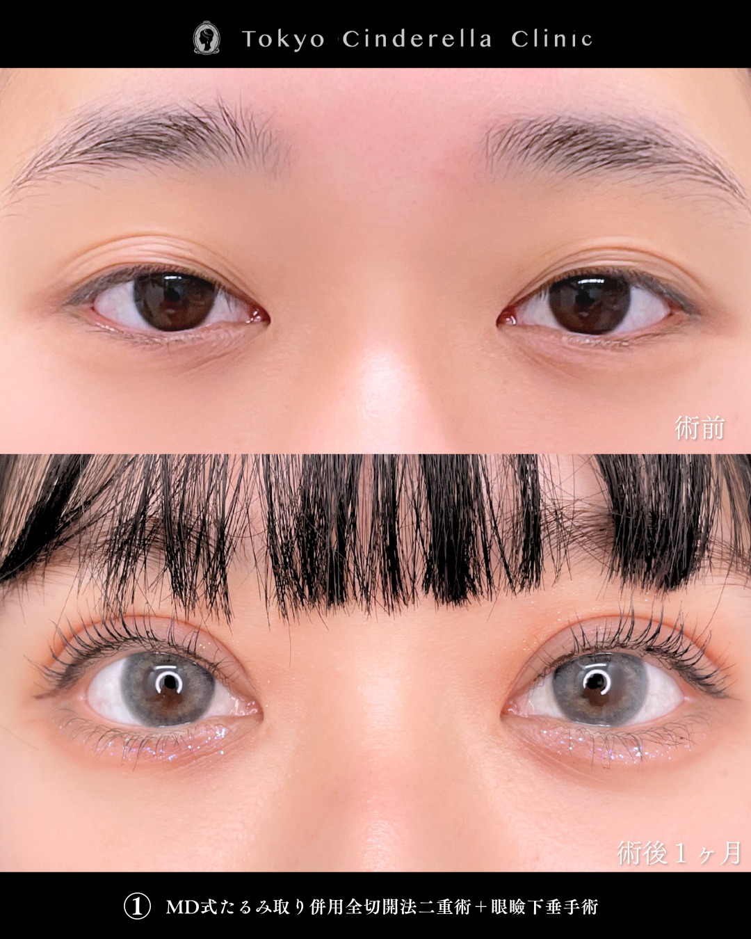 二重全切開と眼瞼下垂手術を行った方の１ヶ月症例