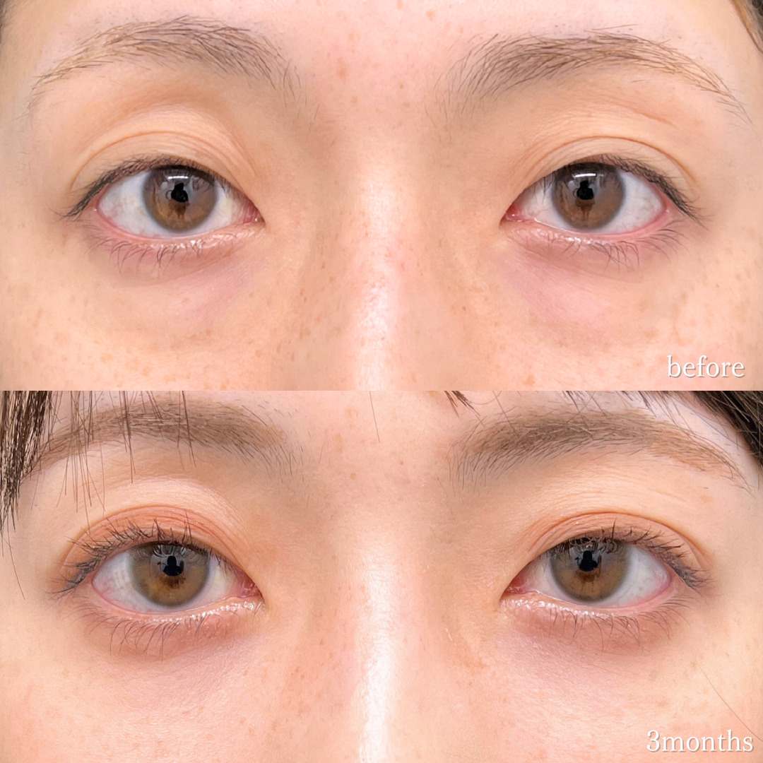 裏ハムラ法で目の下の膨らみが改善し若々しい目元になった20代の３ヶ月症例