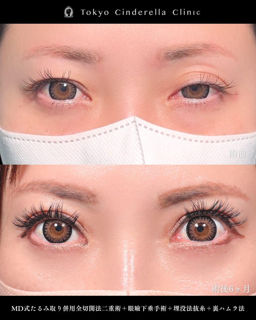 片目のみ重度の眼瞼下垂の方の症例