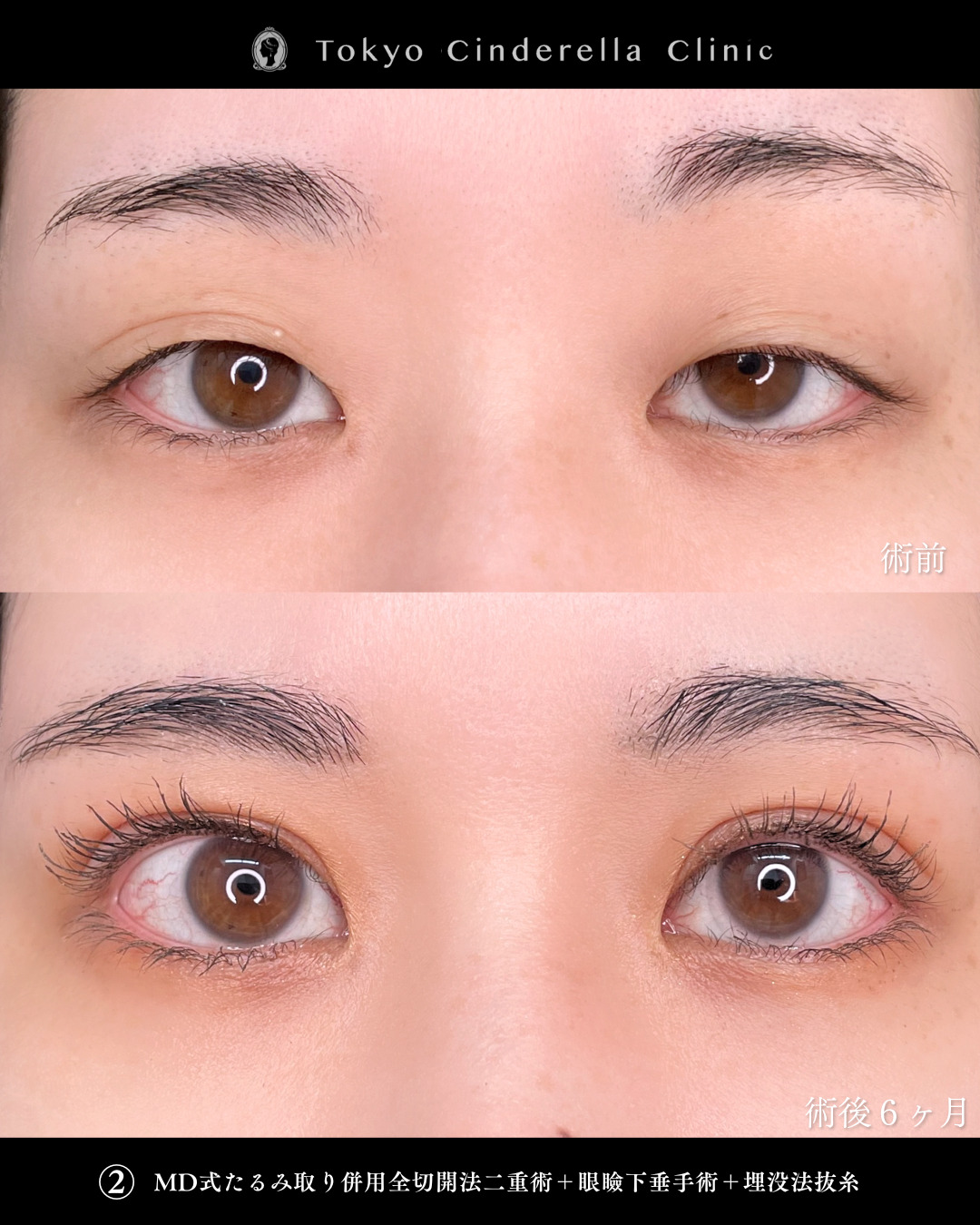眼瞼下垂手術で目の開きの左右差が改善し若々しい目元になった方の６ヶ月目症例
