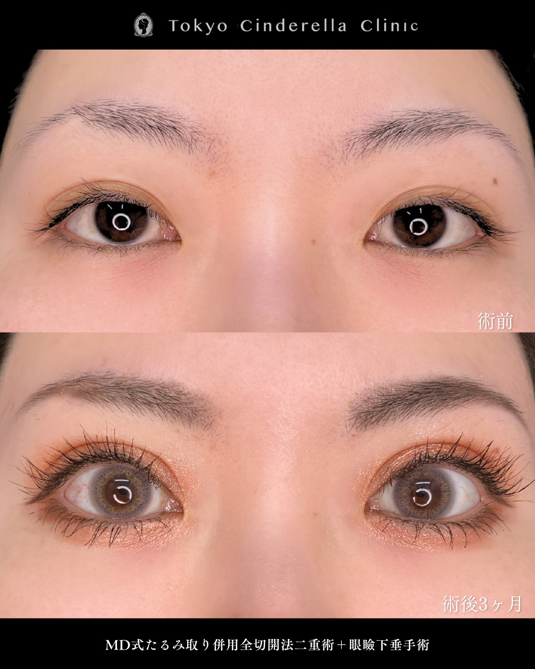 二重切開と眼瞼下垂手術で目の開きが良くなった方の３ヶ月の比較