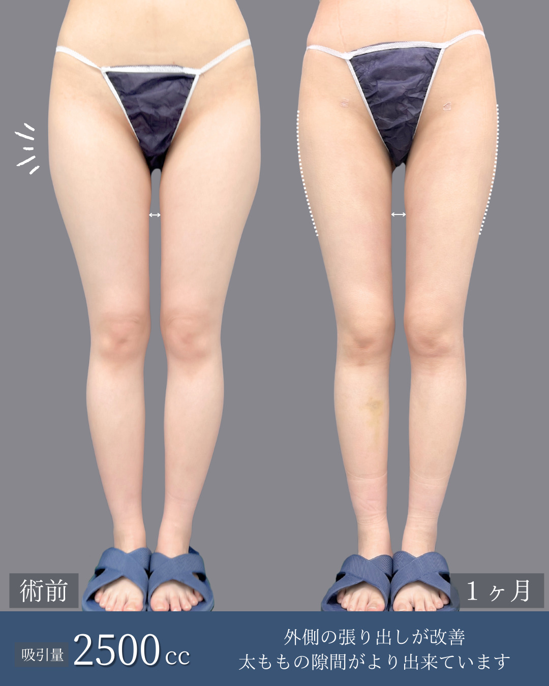 アキーセル脂肪吸引で太ももがしっかり細くなった方の１ヶ月比較