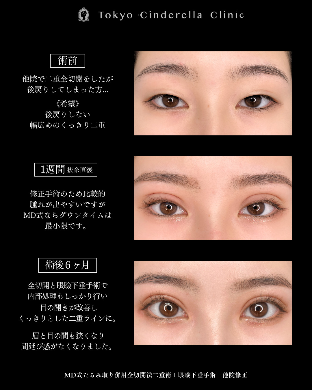 他院修正で二重切開と眼瞼下垂を行った６ヶ月までのダウンタイム症例