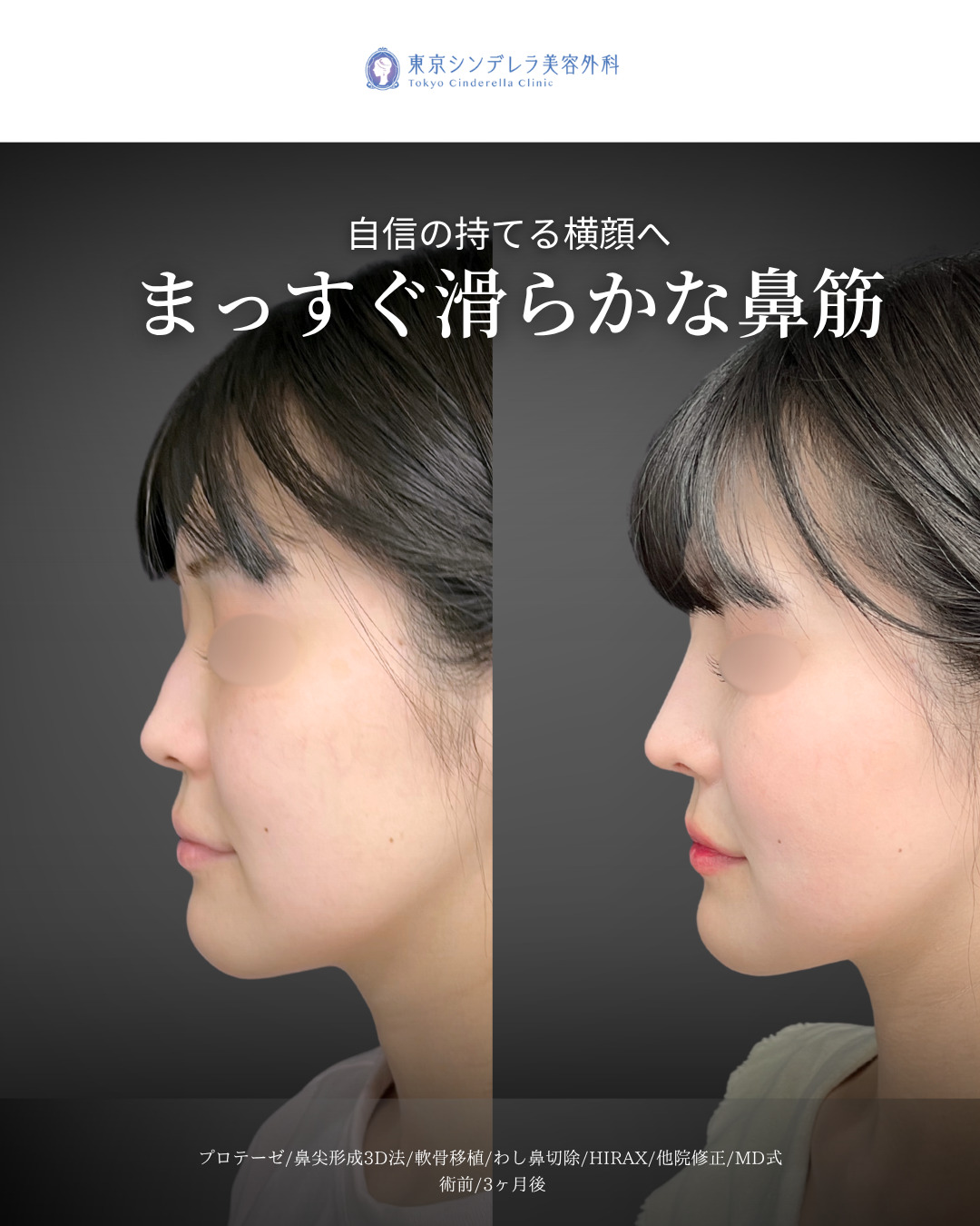 シリコンプロテーゼと鼻尖形成3D法と軟骨移植とわし鼻削りとHIRAXと他院修正をMD式で受けた女性の症例写真