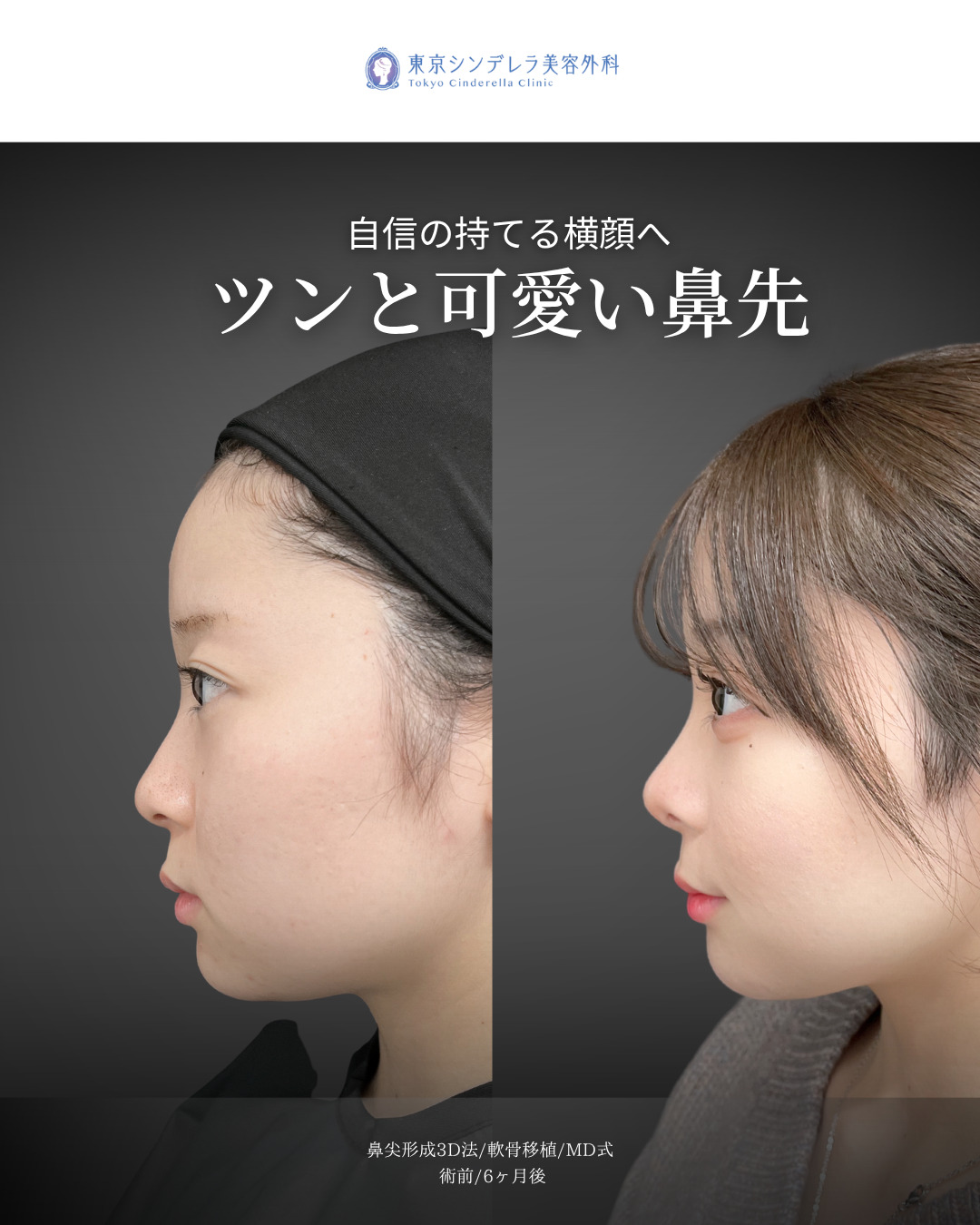 鼻尖形成3D法と軟骨移植をMD式で受けた女性の症例写真