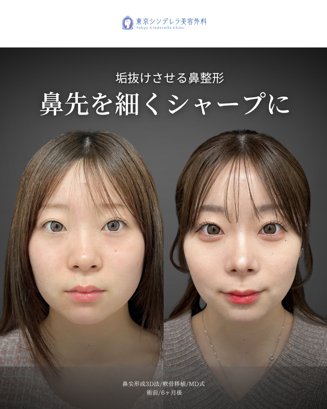 鼻尖形成3D法と軟骨移植をMD式で受けた女性の症例写真