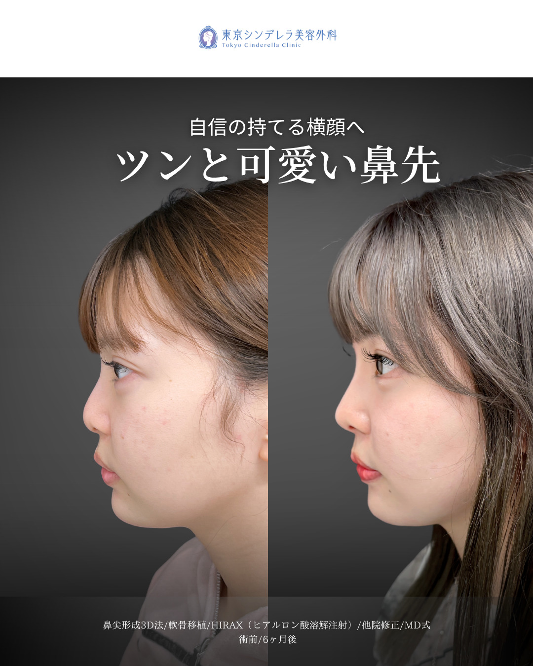 鼻尖形成3D法と軟骨移植とHIRAXと他院修正をMD式で受けた女性の症例写真