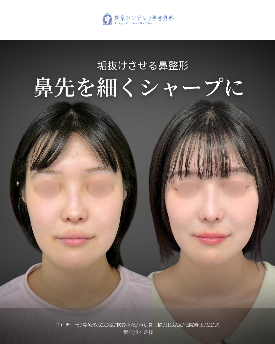 シリコンプロテーゼと鼻尖形成3D法と軟骨移植とわし鼻削りとHIRAXと他院修正をMD式で受けた女性の症例写真