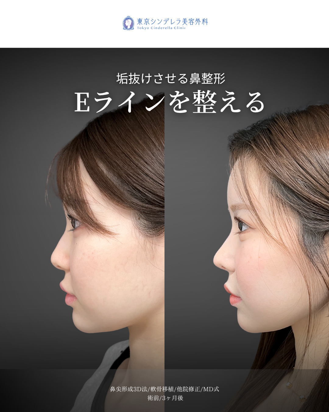 鼻尖形成3D法と軟骨移植をMD式で受けた女性の症例写真