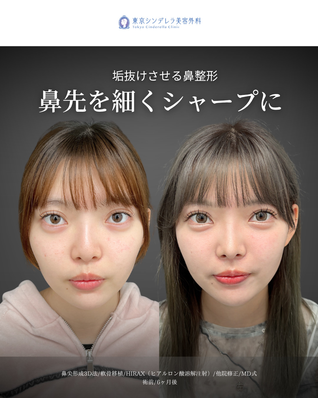 鼻尖形成3D法と軟骨移植とHIRAXと他院修正をMD式で受けた女性の症例写真
