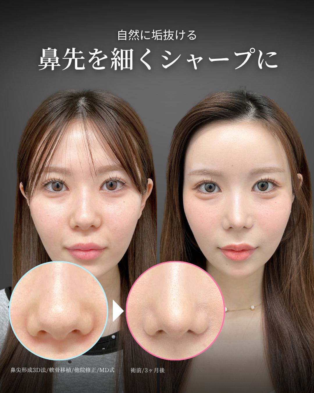 鼻尖形成3D法と軟骨移植をMD式で受けた女性の症例写真