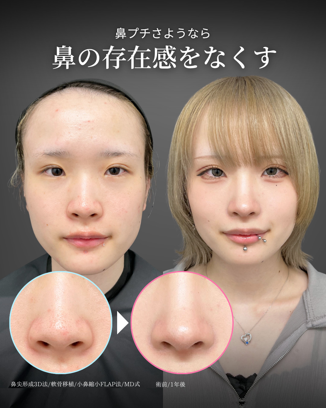 鼻尖形成3D法と軟骨移植と小鼻縮小FLAP法をMD式で受けた女性の症例写真