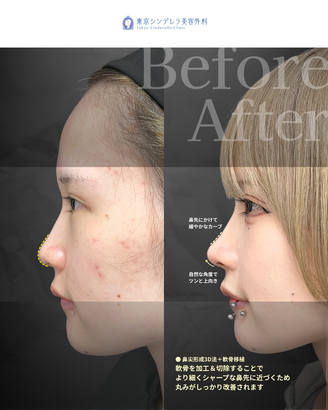 鼻尖形成3D法と軟骨移植と小鼻縮小FLAP法をMD式で受けた女性の症例写真