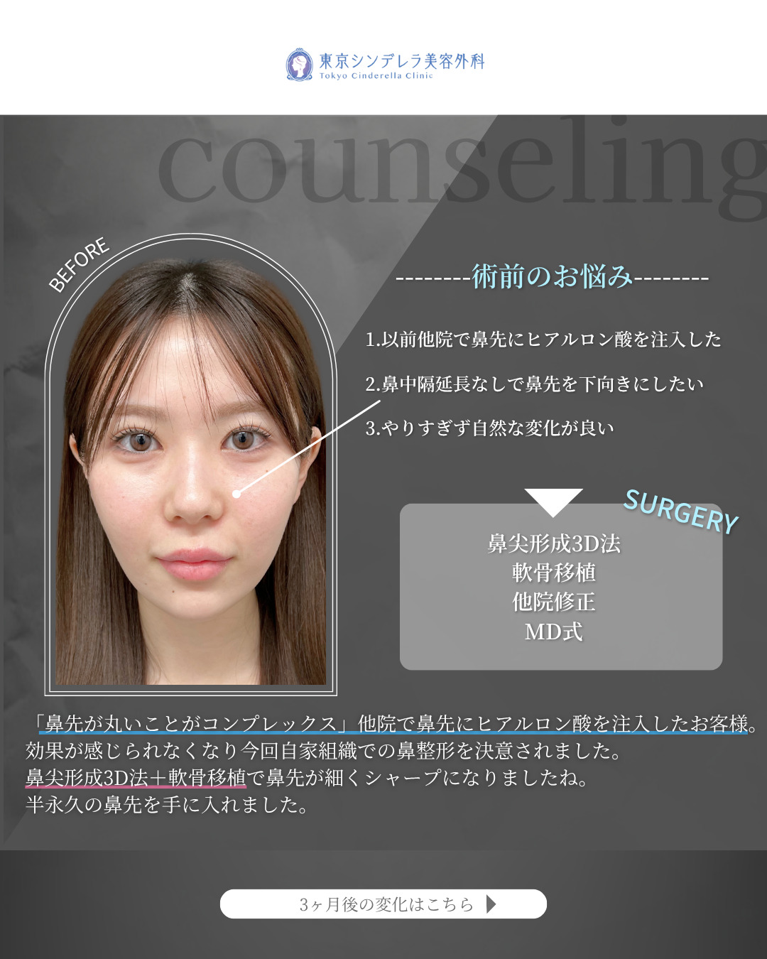 鼻尖形成3D法と軟骨移植をMD式で受けた女性の症例写真
