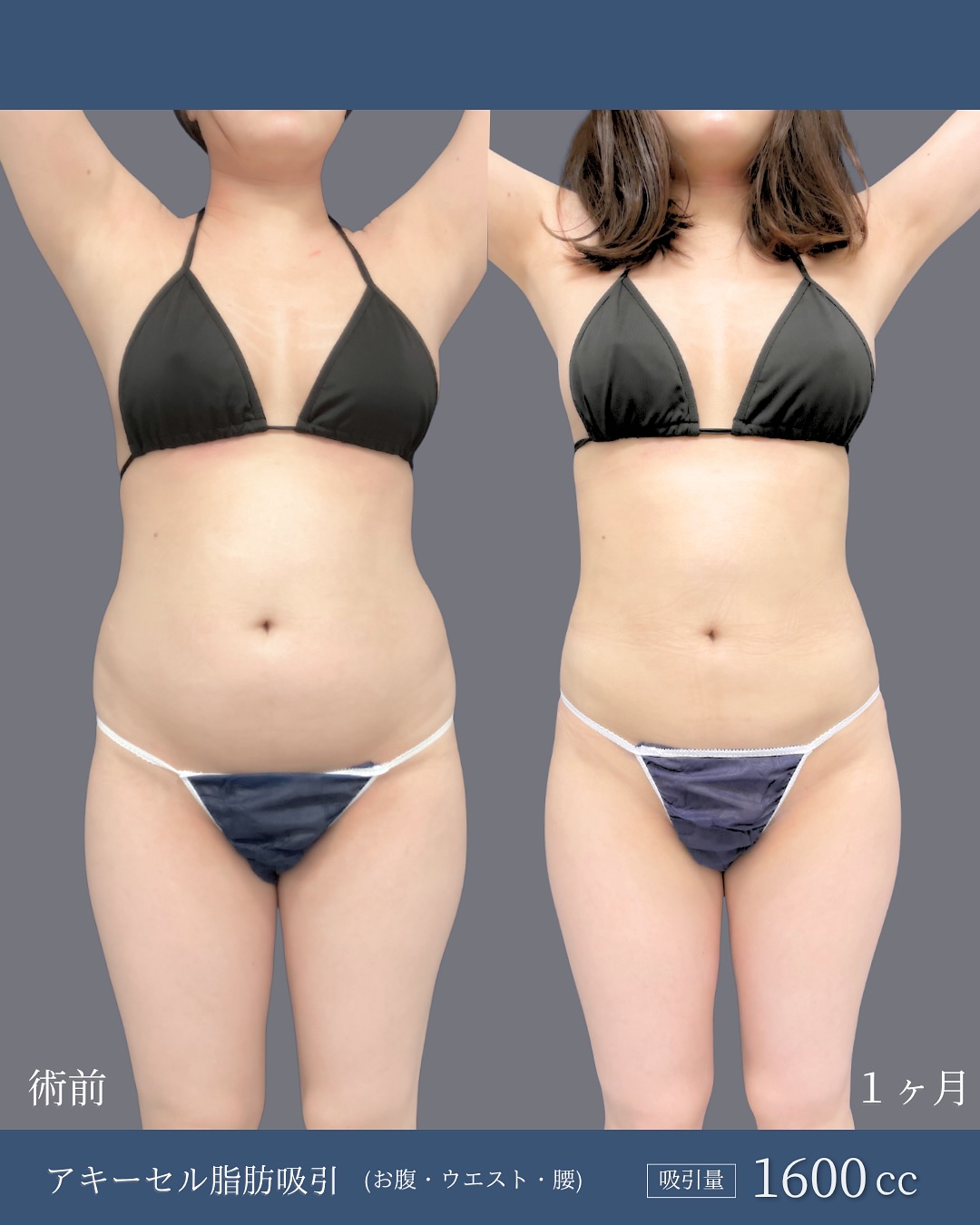 新宿院で行ったお腹とウエストと腰のアキーセル脂肪吸引の症例写真