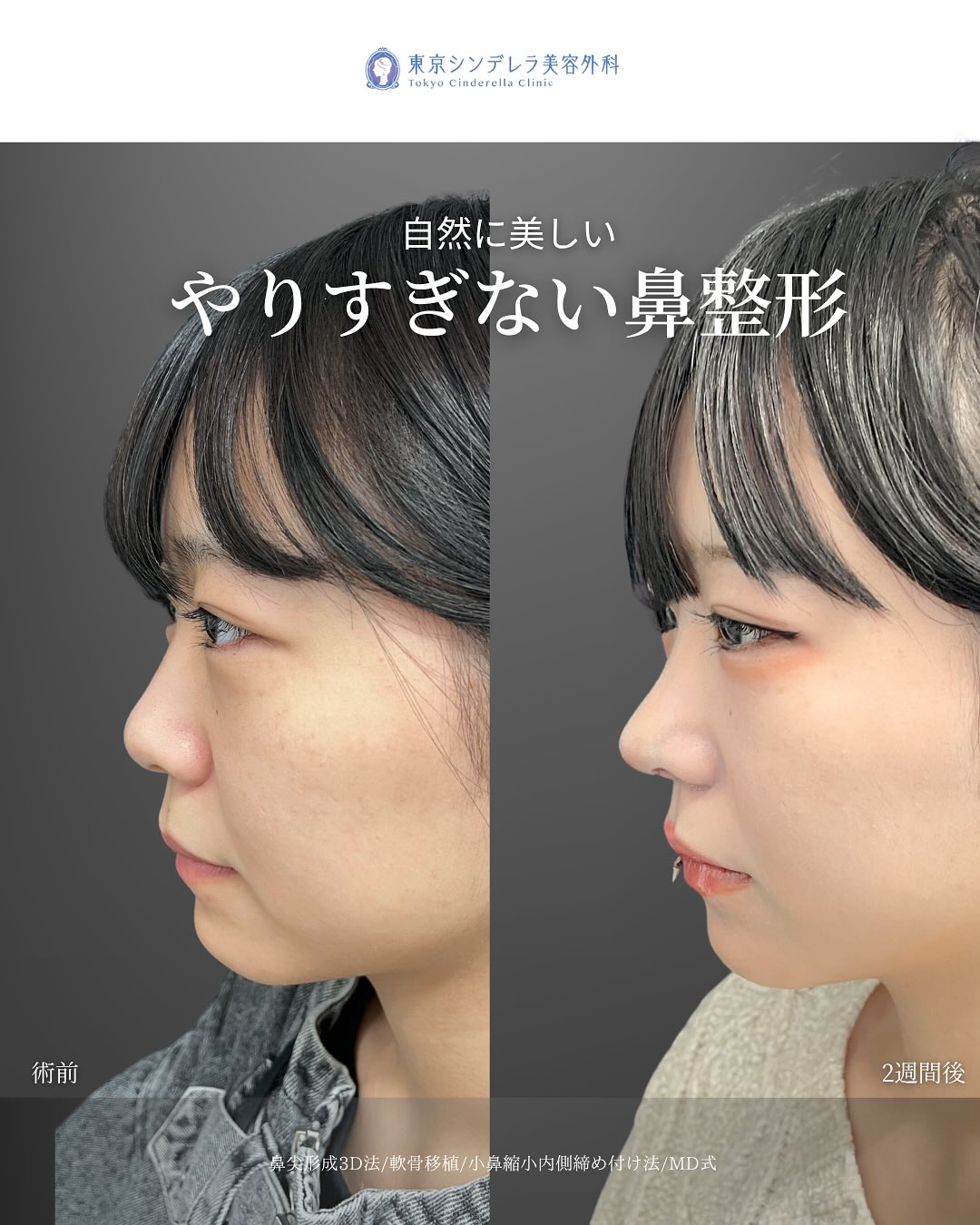 新宿院で行った鼻整形で有名な吉原伯医師のMD式の鼻尖形成3D法と軟骨移植と小鼻縮小内側締め付け法の2週間後の症例写真