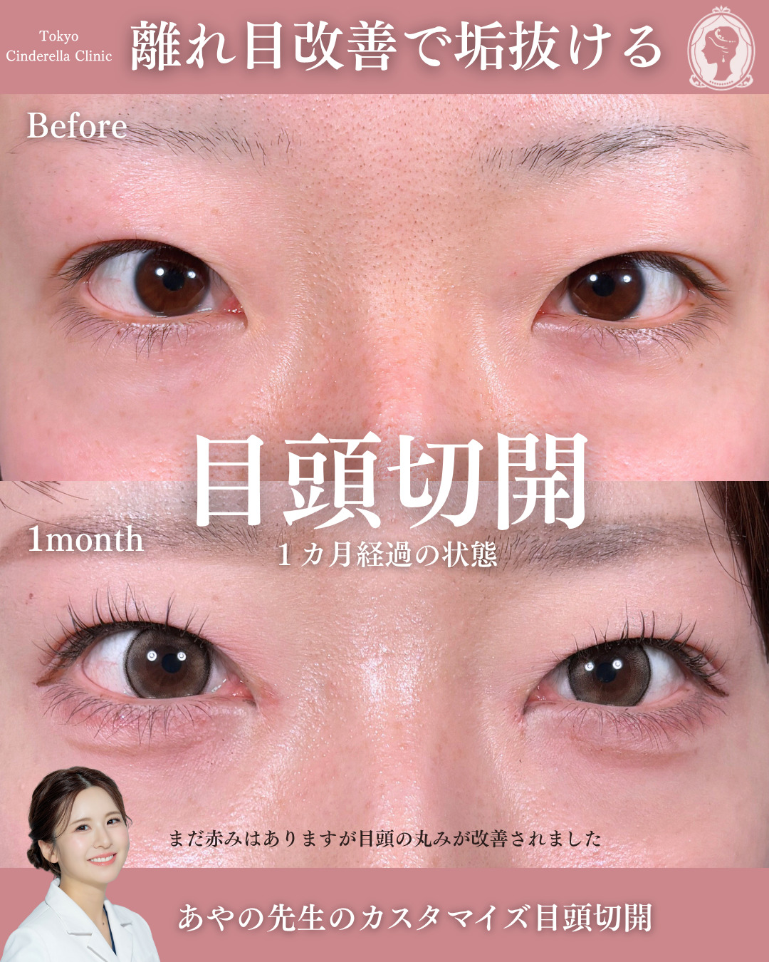 新宿院で行った目頭切開の名医の梅田絢乃医師の症例写真
