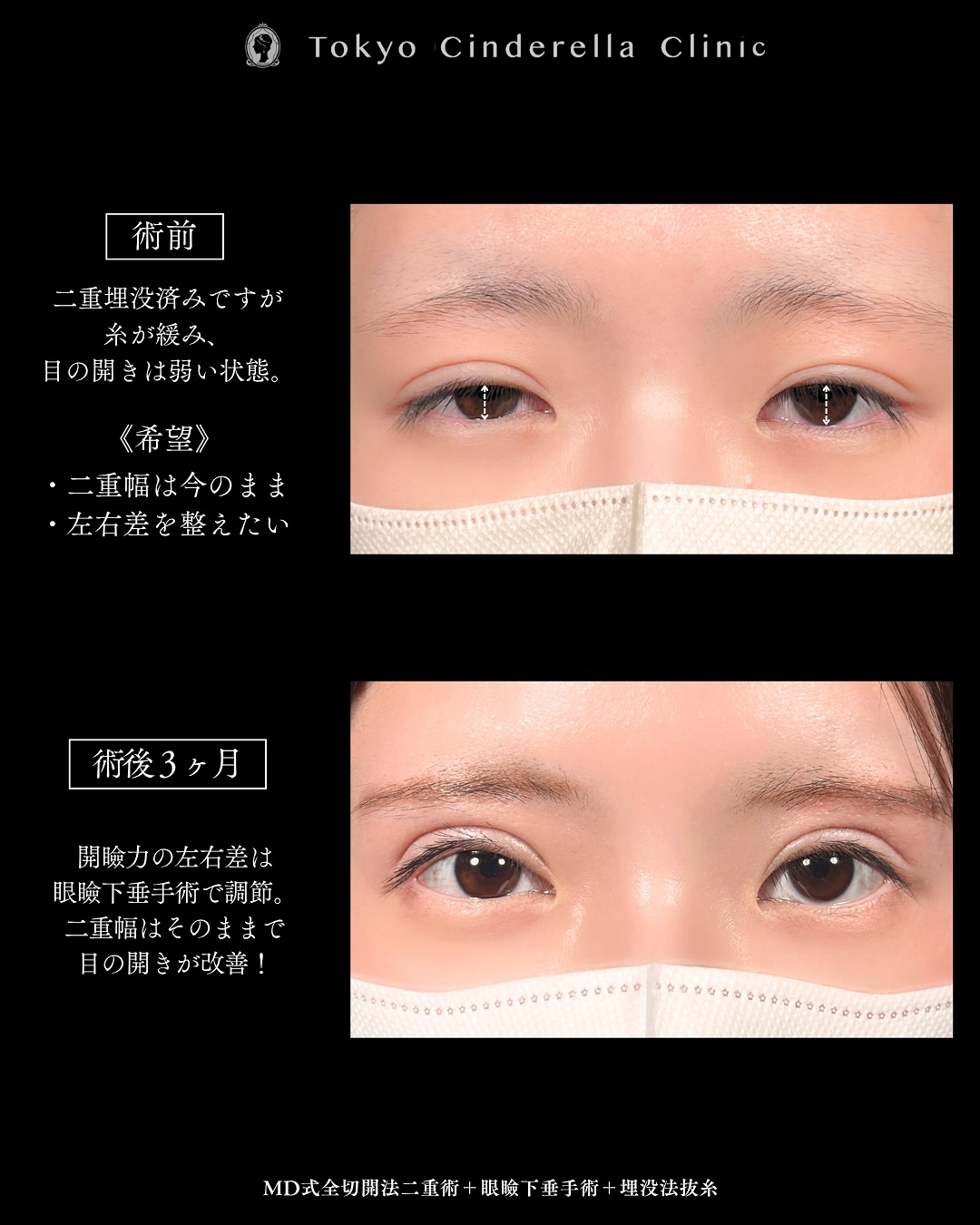 新宿院で行った二重整形で有名な吉原伯医師のMD式の全切開法二重術と眼瞼下垂手術の3ヵ月後の症例写真