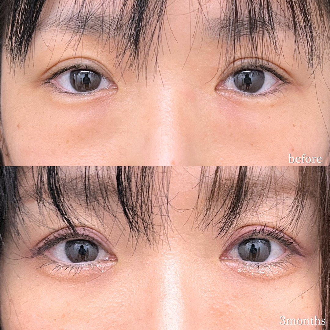 切らないクマ取りと目の下・ゴルゴラインのヒアルロン酸注入で若々しい目元になった30代の症例